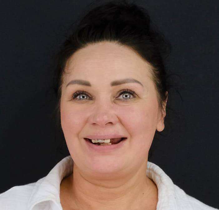 Before: All on 6 Implants & Zirconium Crowns, Antalya, Türkiye