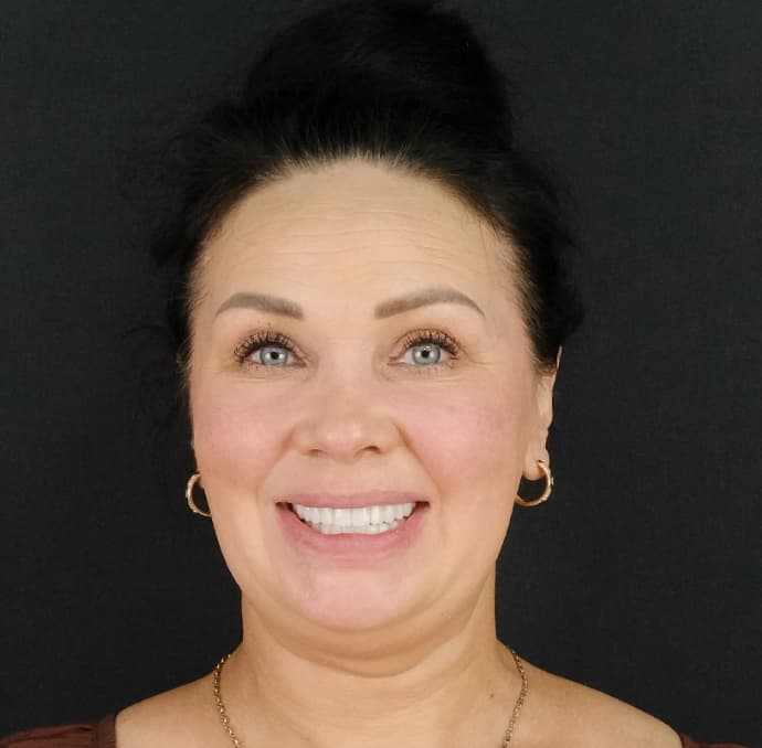 After: All on 6 Implants & Zirconium Crowns, Antalya, Türkiye