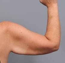 Before: Arm Lift and Liposuction, Antalya, Türkiye
