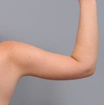 After: Arm Lift and Liposuction, Antalya, Türkiye