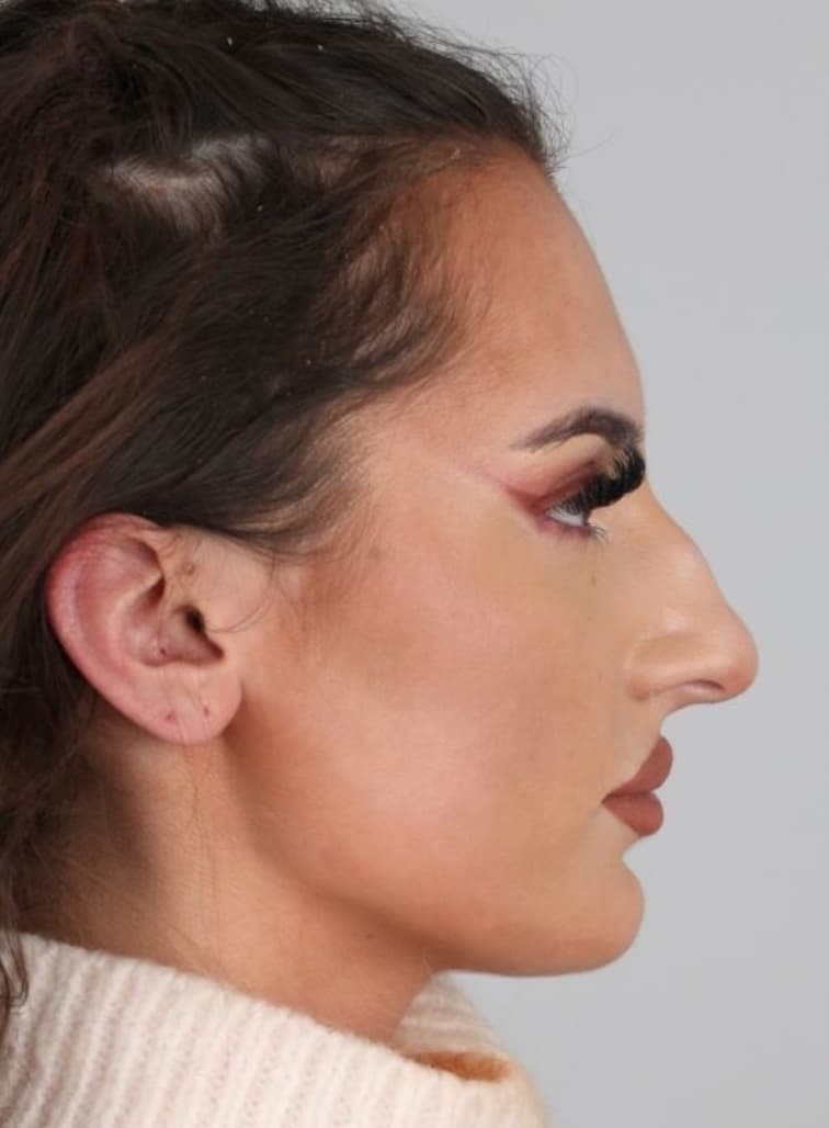 Before: Rhinoplasty, Antalya, Türkiye