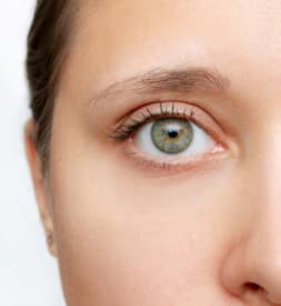 After: Blepharoplasty, Antalya, Türkiye