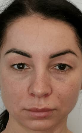 Before: Upper Eyelids Blepharoplasty, San Jose, Costa Rica