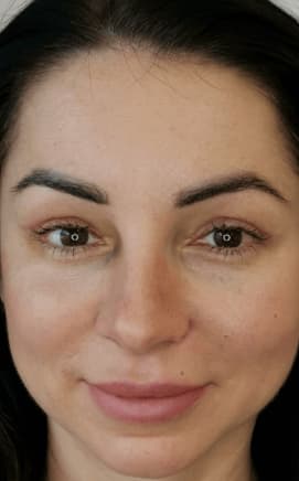 After: Upper Eyelids Blepharoplasty, San Jose, Costa Rica