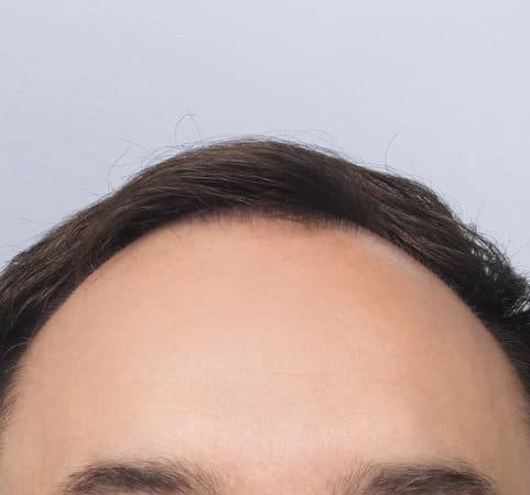 Before: Hair Transplant, Antalya, Türkiye