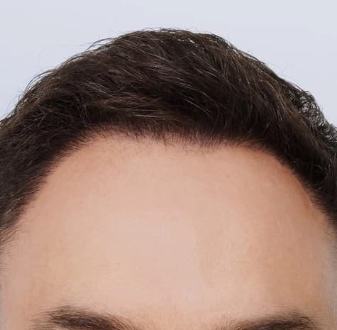 After: Hair Transplant, Antalya, Türkiye