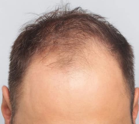 Before: Hair Transplant, Istanbul, Türkiye