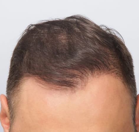 After: Hair Transplant, Istanbul, Türkiye